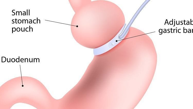 gastric-banding