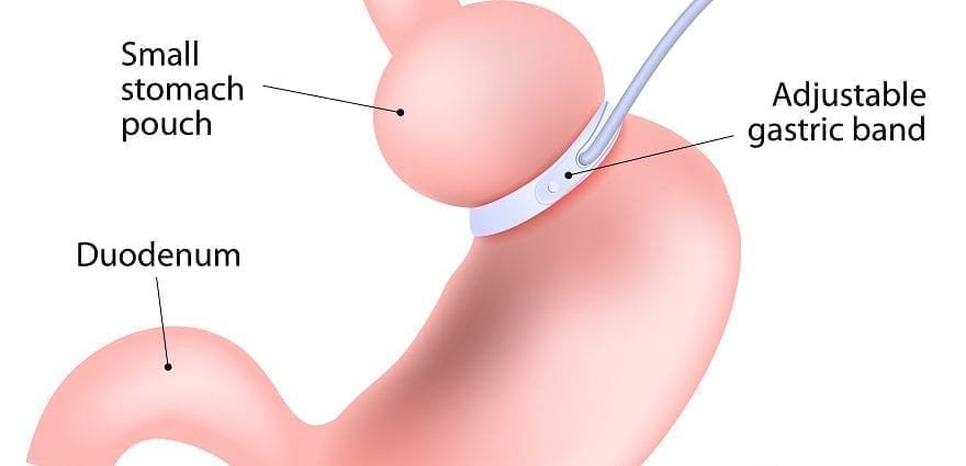 The Risks Of Laparoscopic Adjustable Gastric Band Surgery