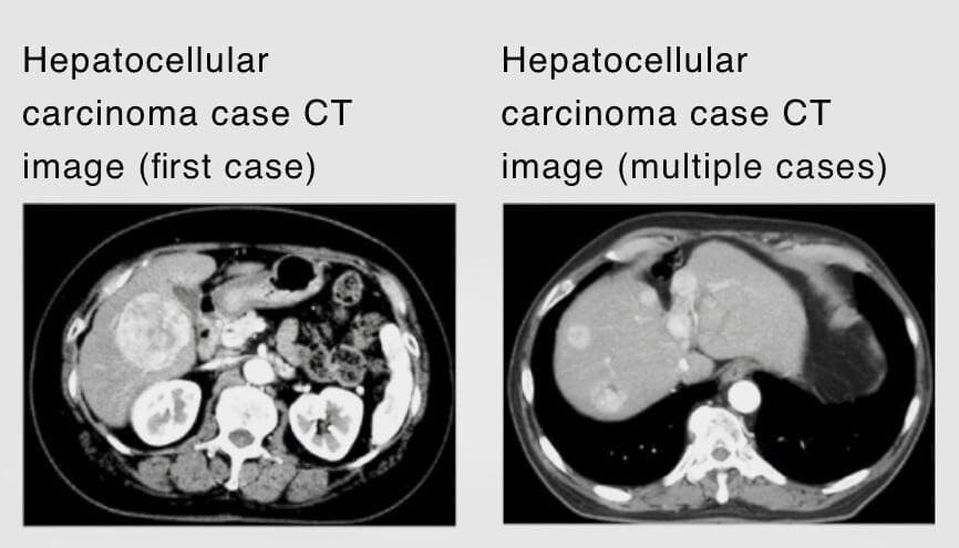 hepatocellular