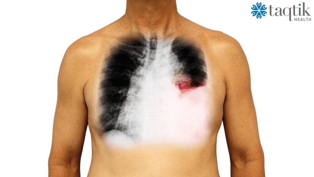 Early Signs of Lung Cancer