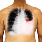 Early Signs of Lung Cancer