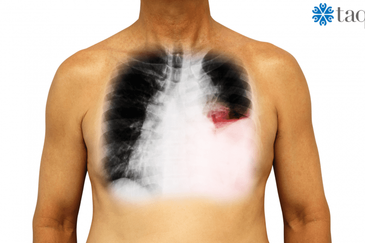 early Signs of Lung Cancer