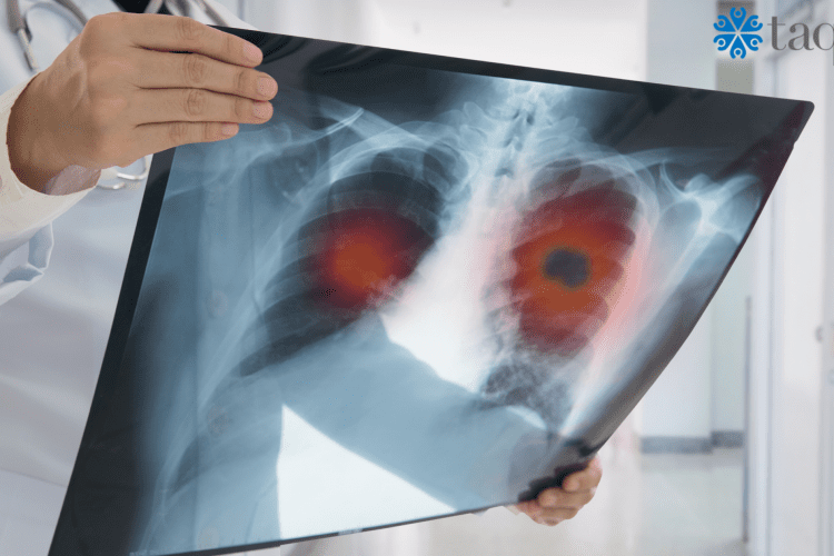 lung cancer