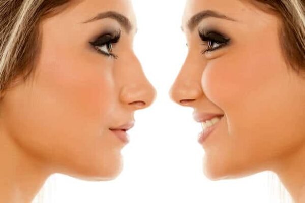 Nose Reduction